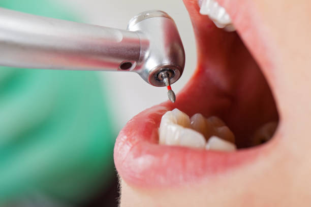 Best Emergency Root Canal Treatment in Proctor, VT